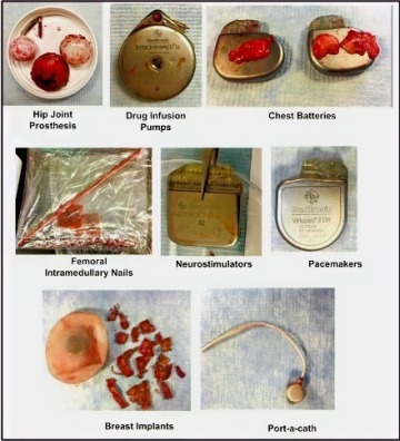 Biomedical Implant examples